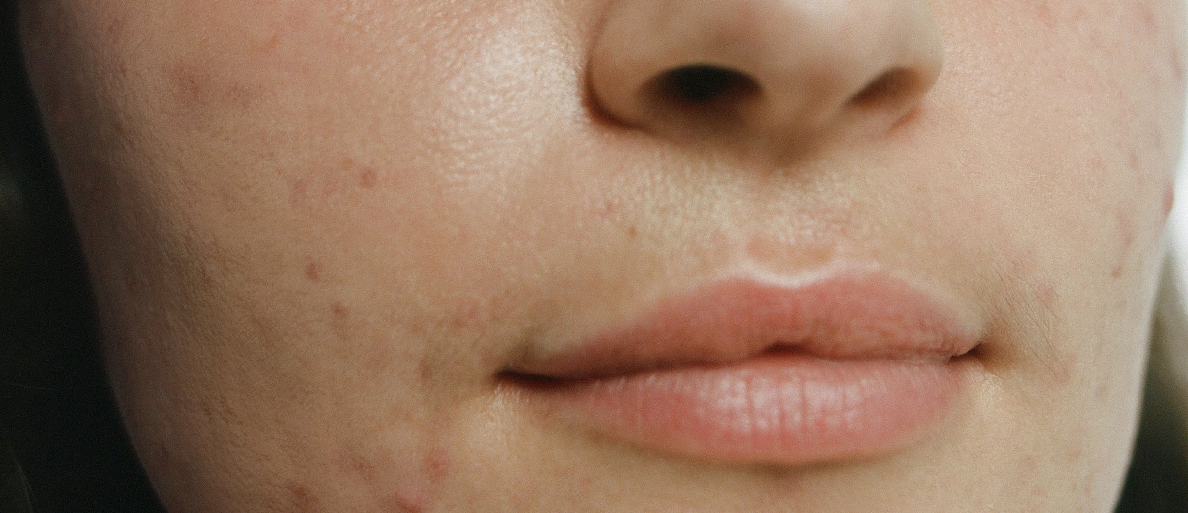 Are acne scars permanent?