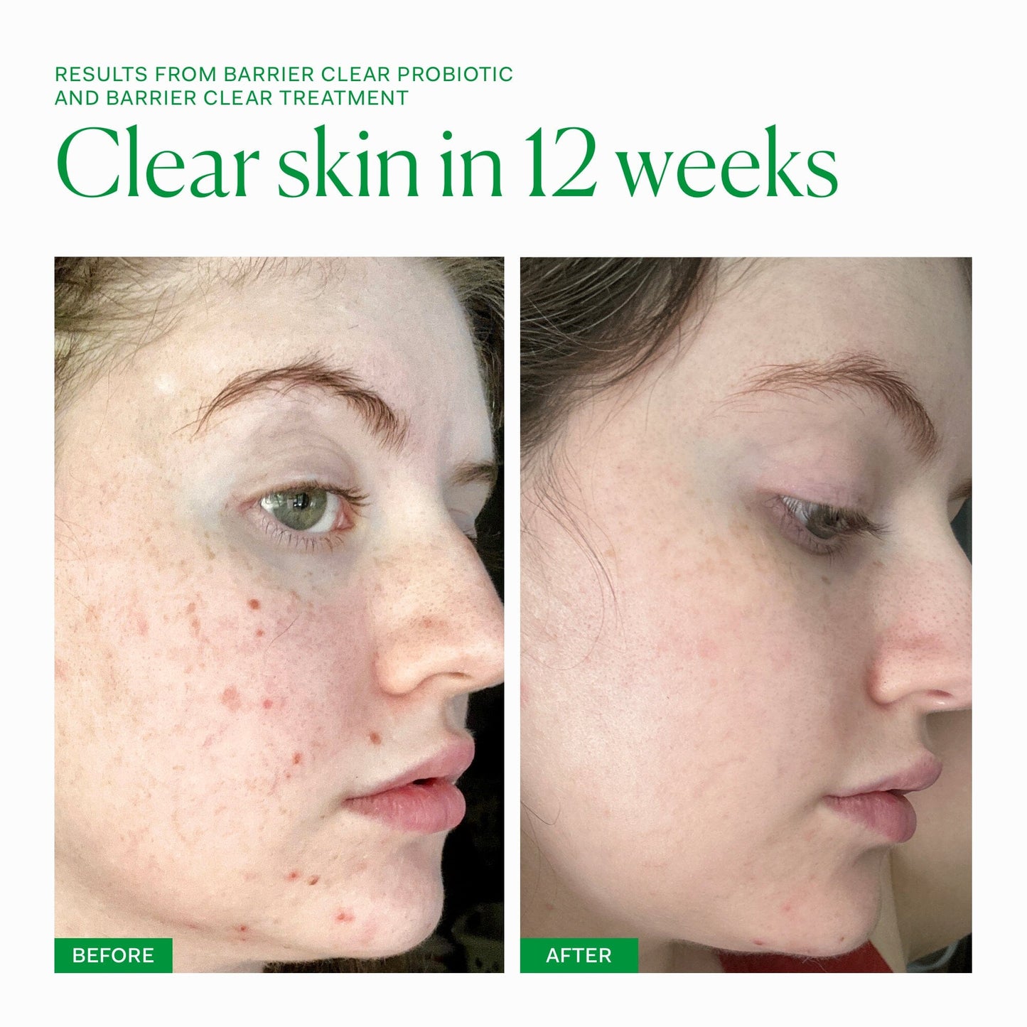 Barrier Clear Treatment single The Nue Co.