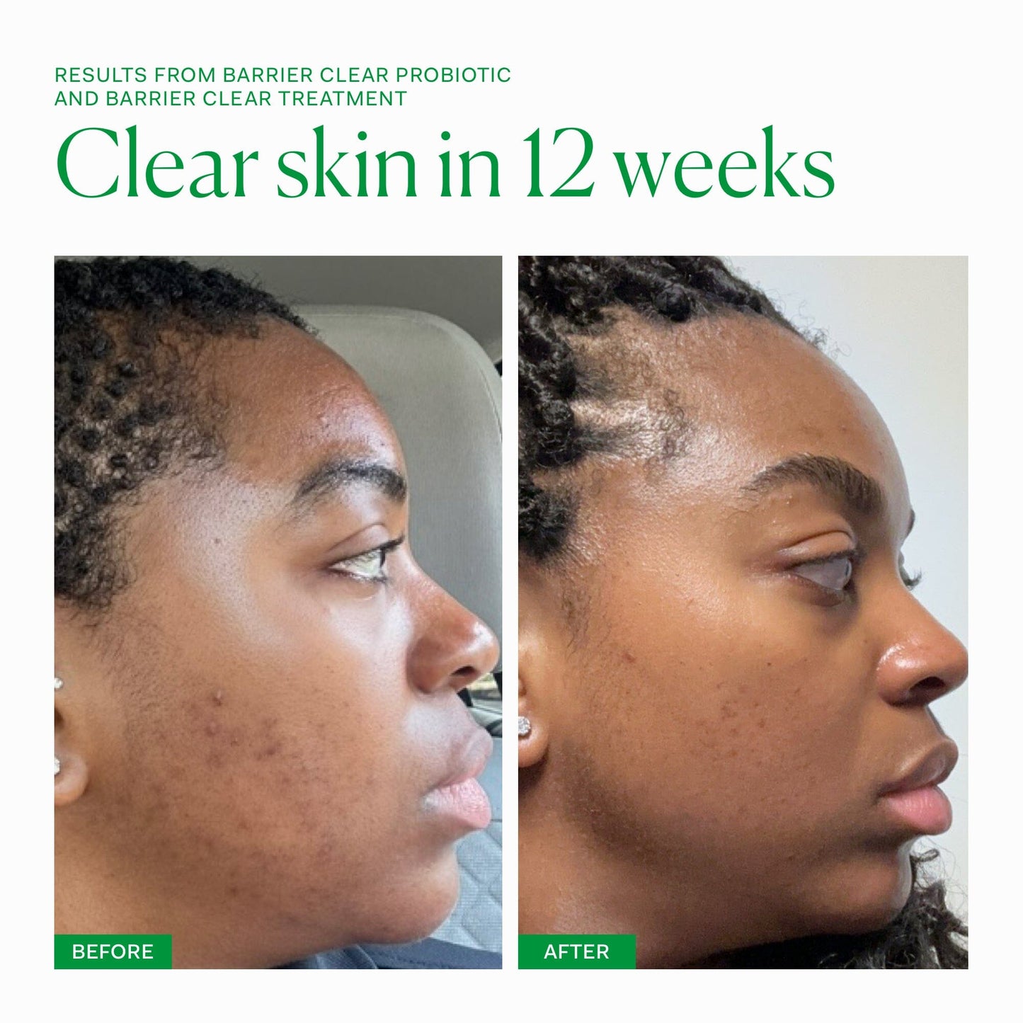 Barrier Clear Treatment single The Nue Co.