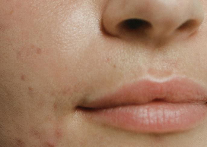 Are acne scars permanent?