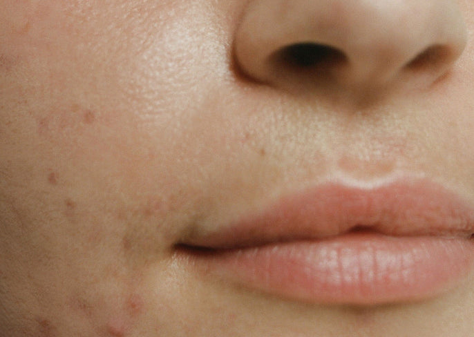 Are acne scars permanent?